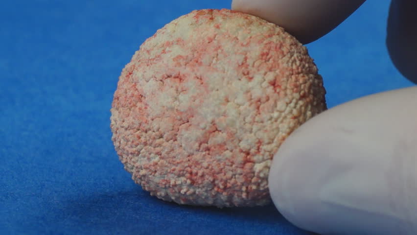 bladder stones diet veterinarian showing extremely large bladder removed from a calcium oxalate bladder stones diet veterinarian showing extremely large bladder removed from a calcium oxalate