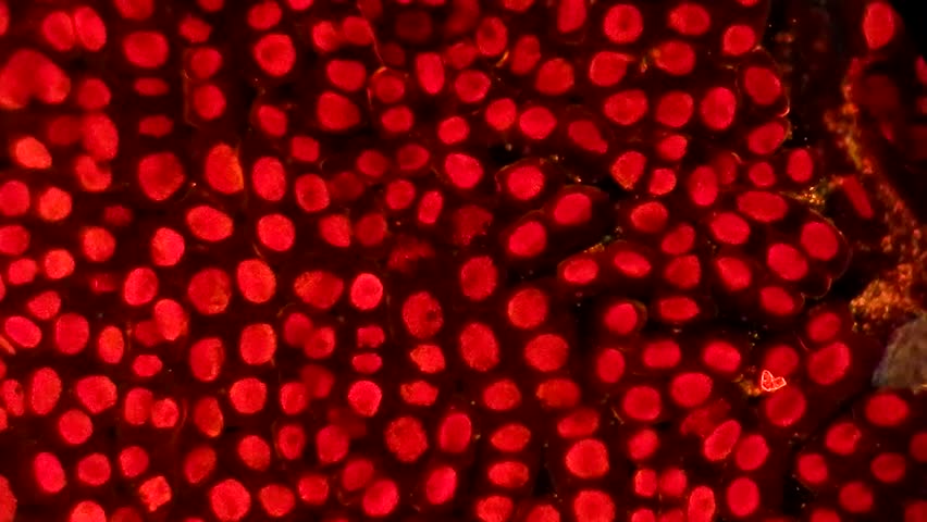 Full HD. Original Video Of Many Cancer Cells With Big Red Nucleus Under ...